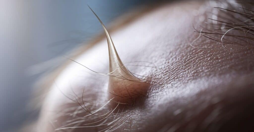 Close up of a 1 millimeter growing hair strand emerging from the scalp.